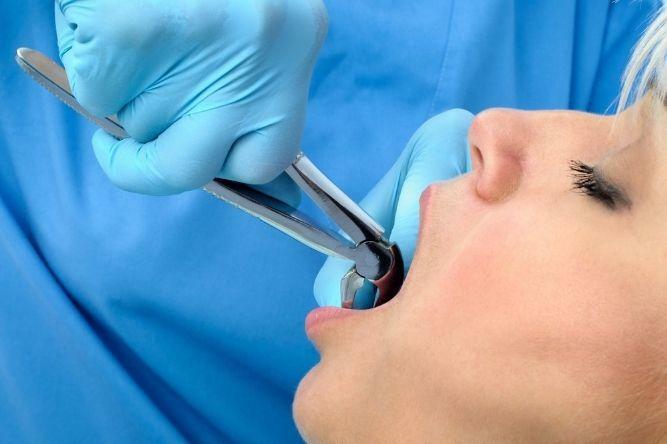tooth extract being done by a dentist