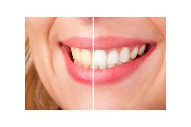 a before and after photo of teeth