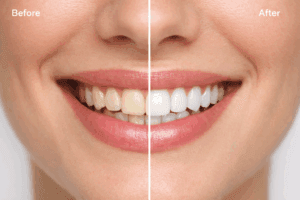 teeth whitening bridgwater trails