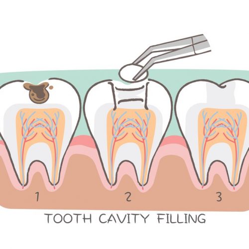 Dental Fillings In Winnipeg | Affinity Dental Clinic